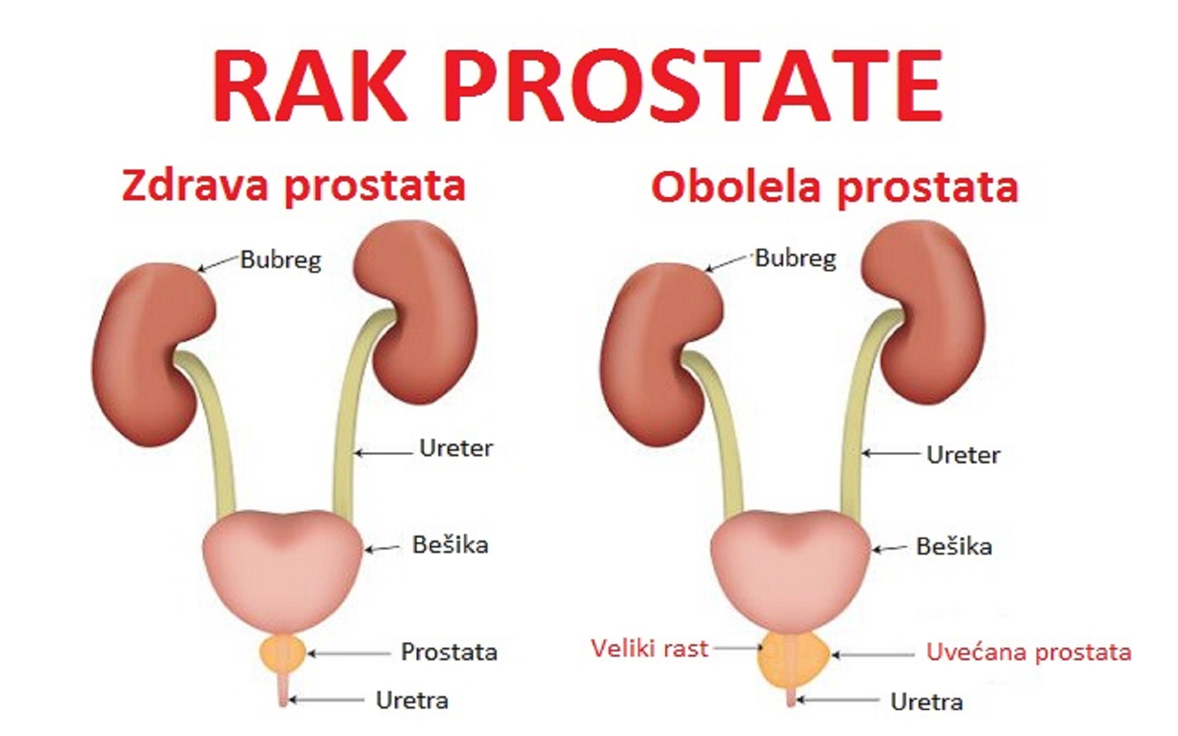mi okozott krónikus prosztatitis